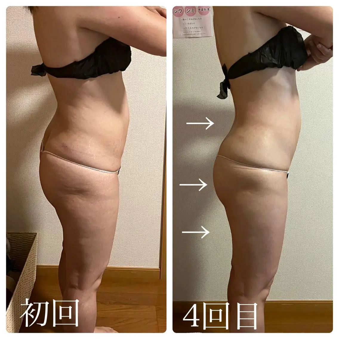 【部分ボディケア👙】気になる部分を集中ケア✨すっきりとしたボディラインを目指したい方におすすめです‼️の写真