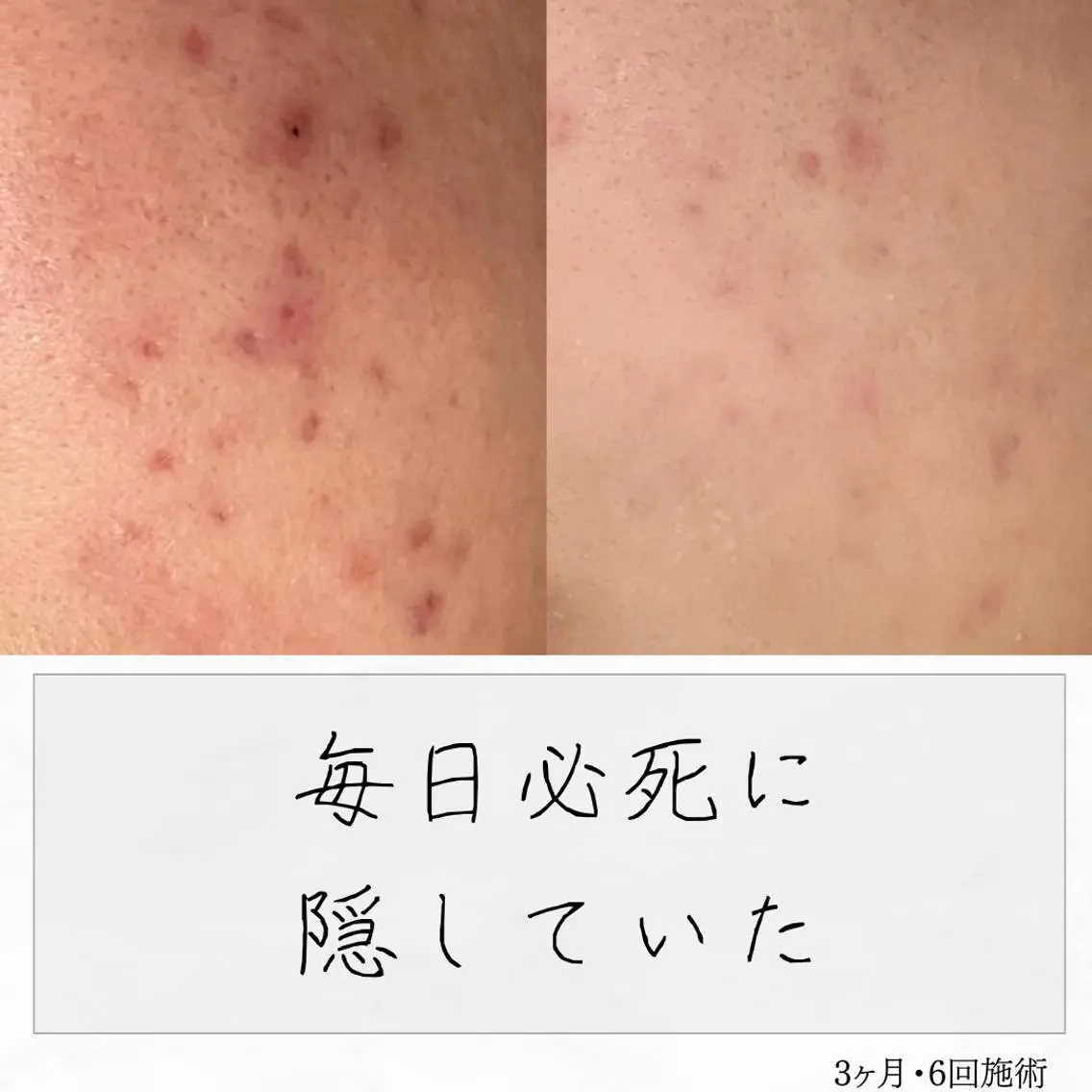 ニキビ経験者が施術 する専門サロン🌻のエステ・リラクイメージ