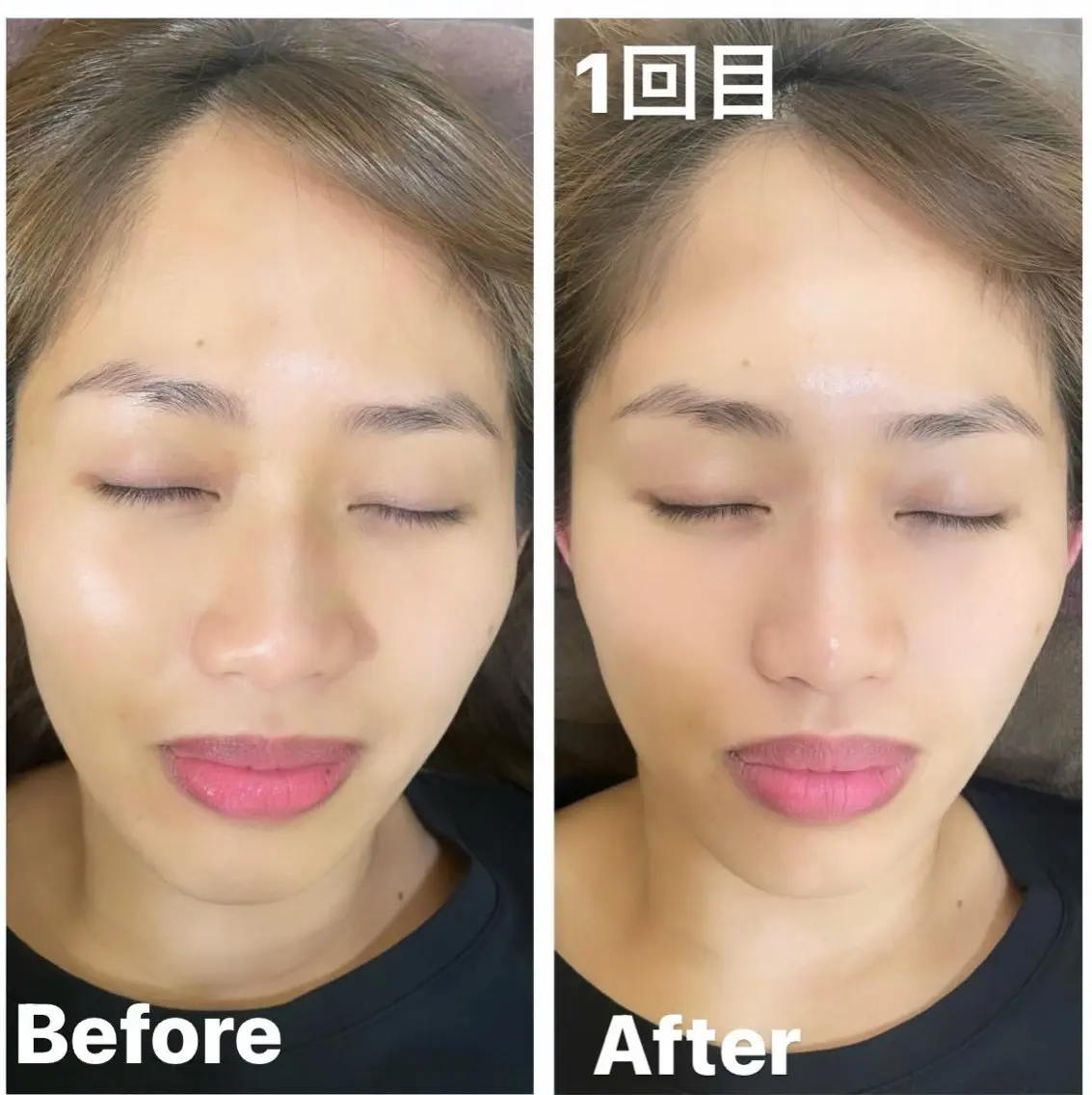 小顔矯正💆♀️💎ブライダルにも♡の写真