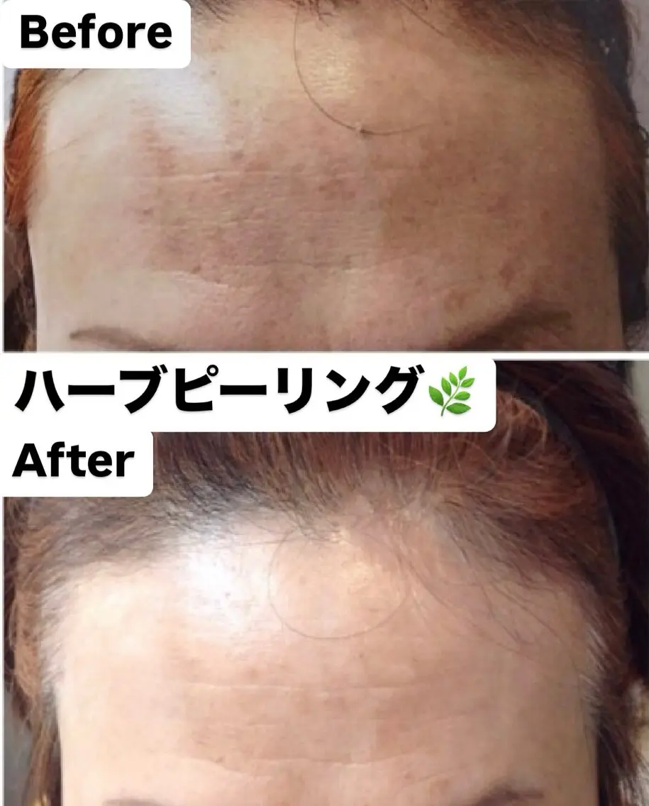 【デコルテリンパ付】ハーブピーリング2g＋ヒト幹細胞パック🌿肌再生＆艶UP✨の写真