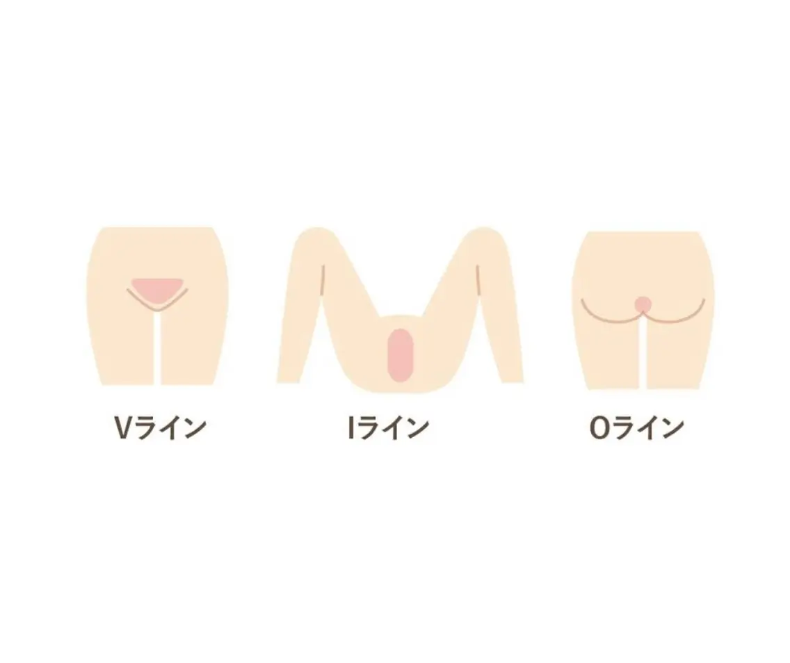 【男性限定】　VIO    ダブル脱毛（ブラジリアンワックス＋光脱毛の組み合わせ◎）の写真