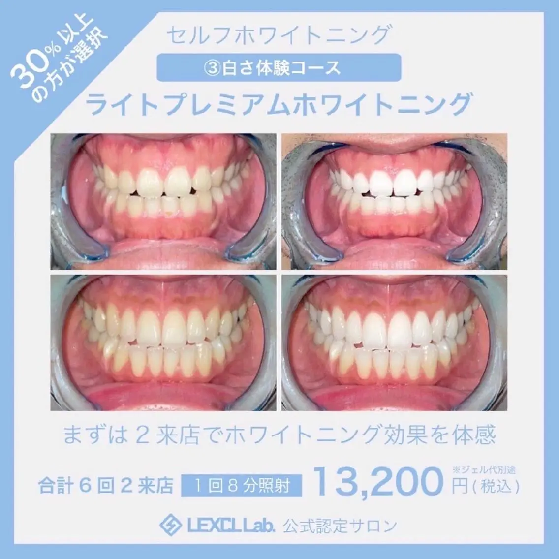 【初回限定・白さを極める】真っ白お約束･ ライトプレミアムホワイトニング❣〈合計 60分照射 2 来店〉❣の写真