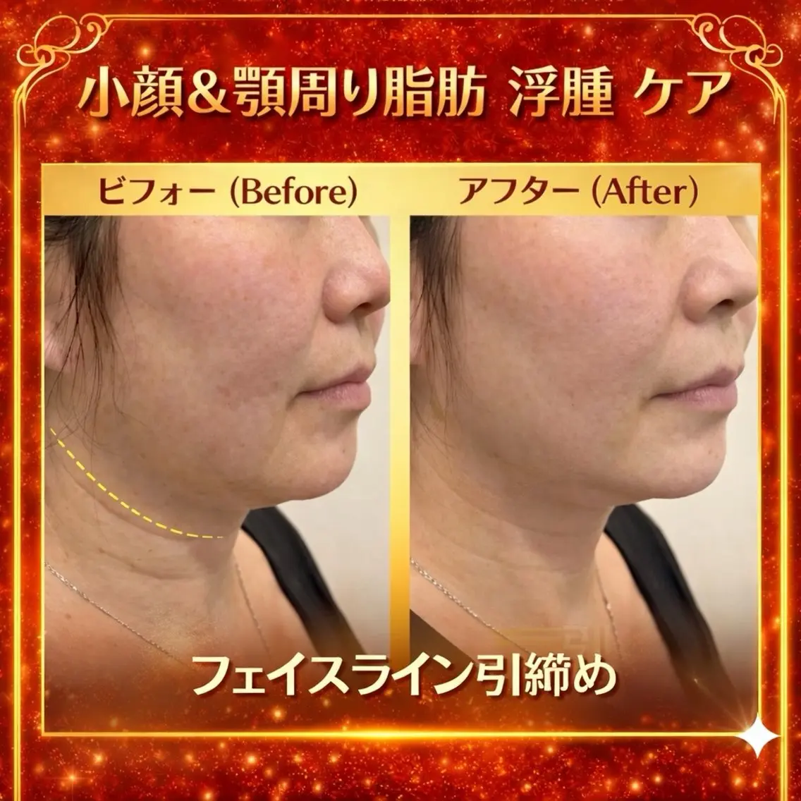 顎下 フェイスライン たるみの写真