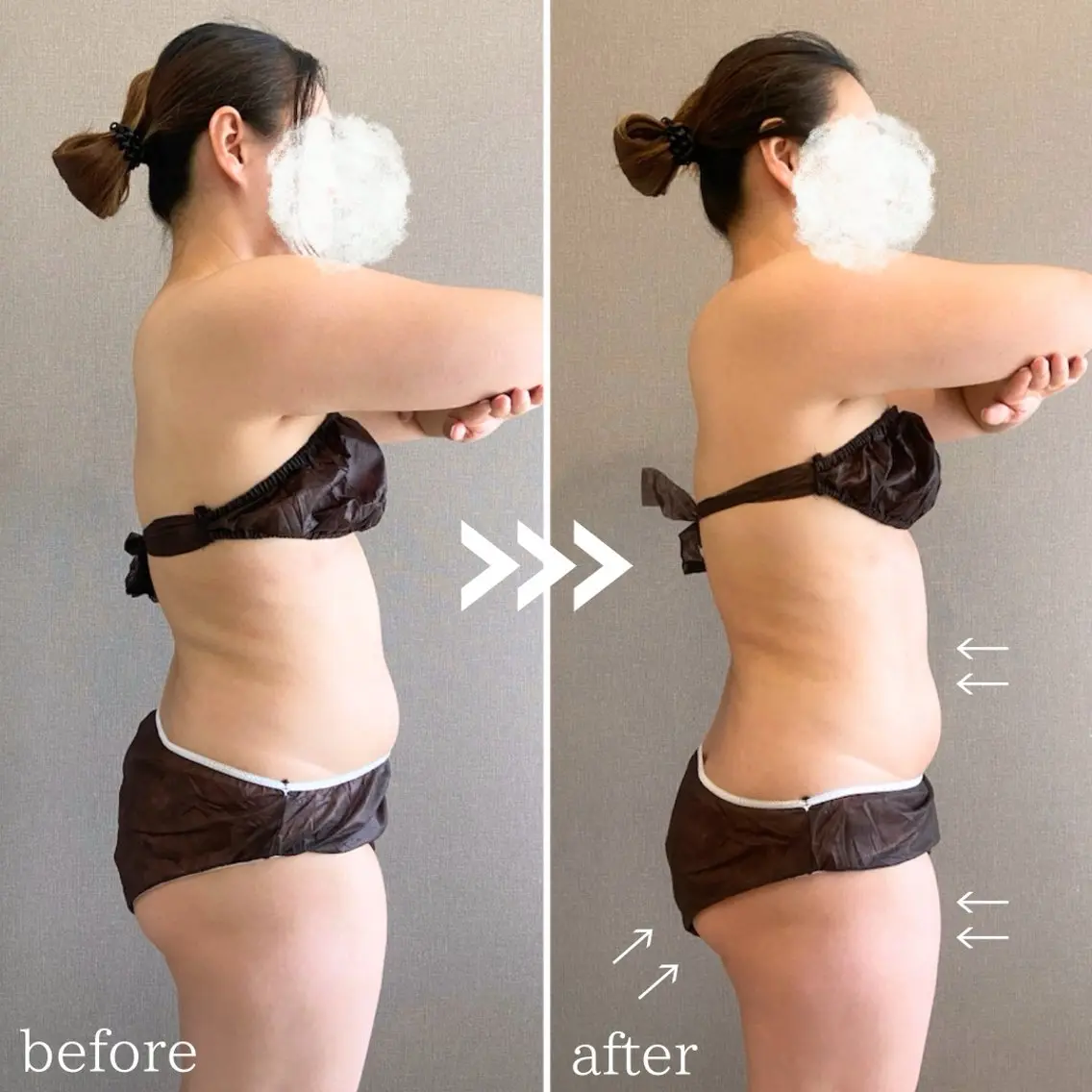 ダイエット応援価格‼️📣【二の腕、お腹、背中】最新機器を使い身体水脈を整え太りにくい身体に❣️の写真