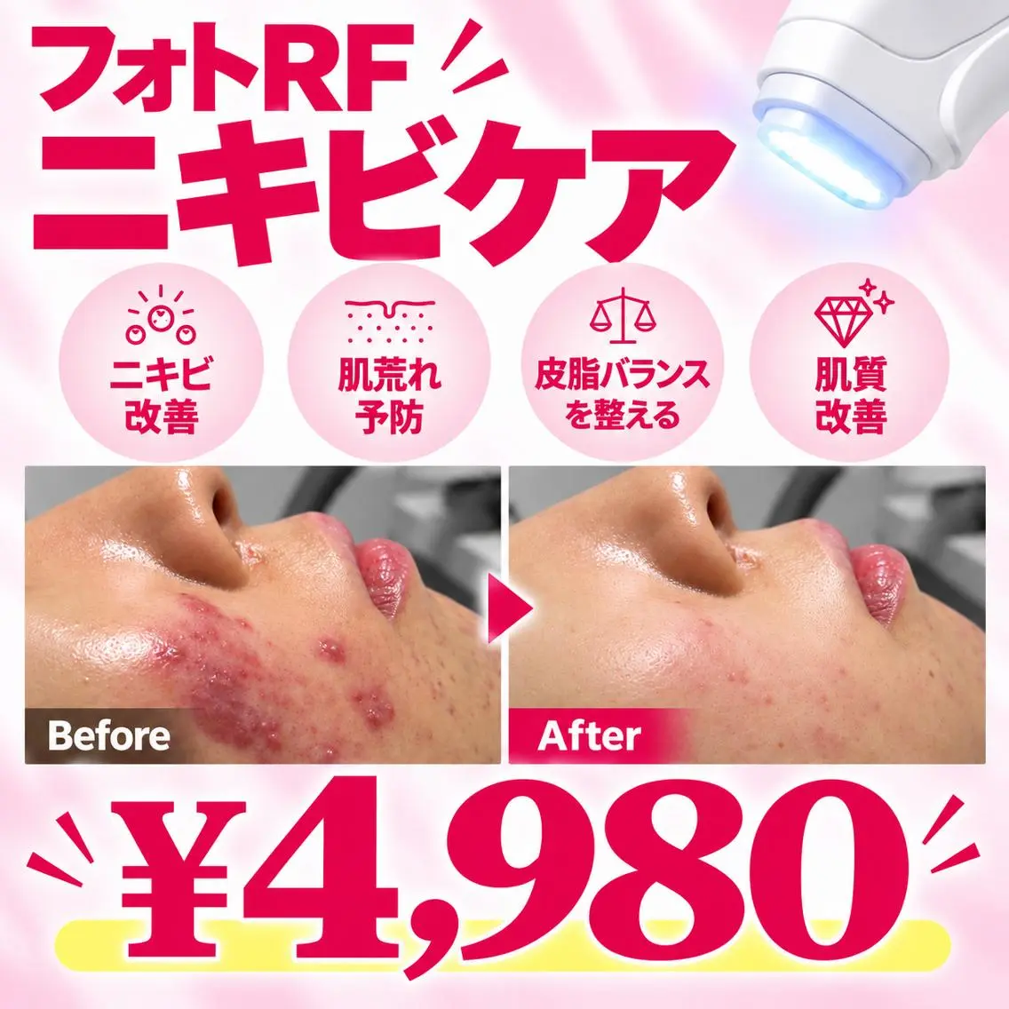 【徹底ニキビケア✨】結果を出したい方へ!フォトRF肌質改善・ニキビ・跡解消 ¥4,980の写真
