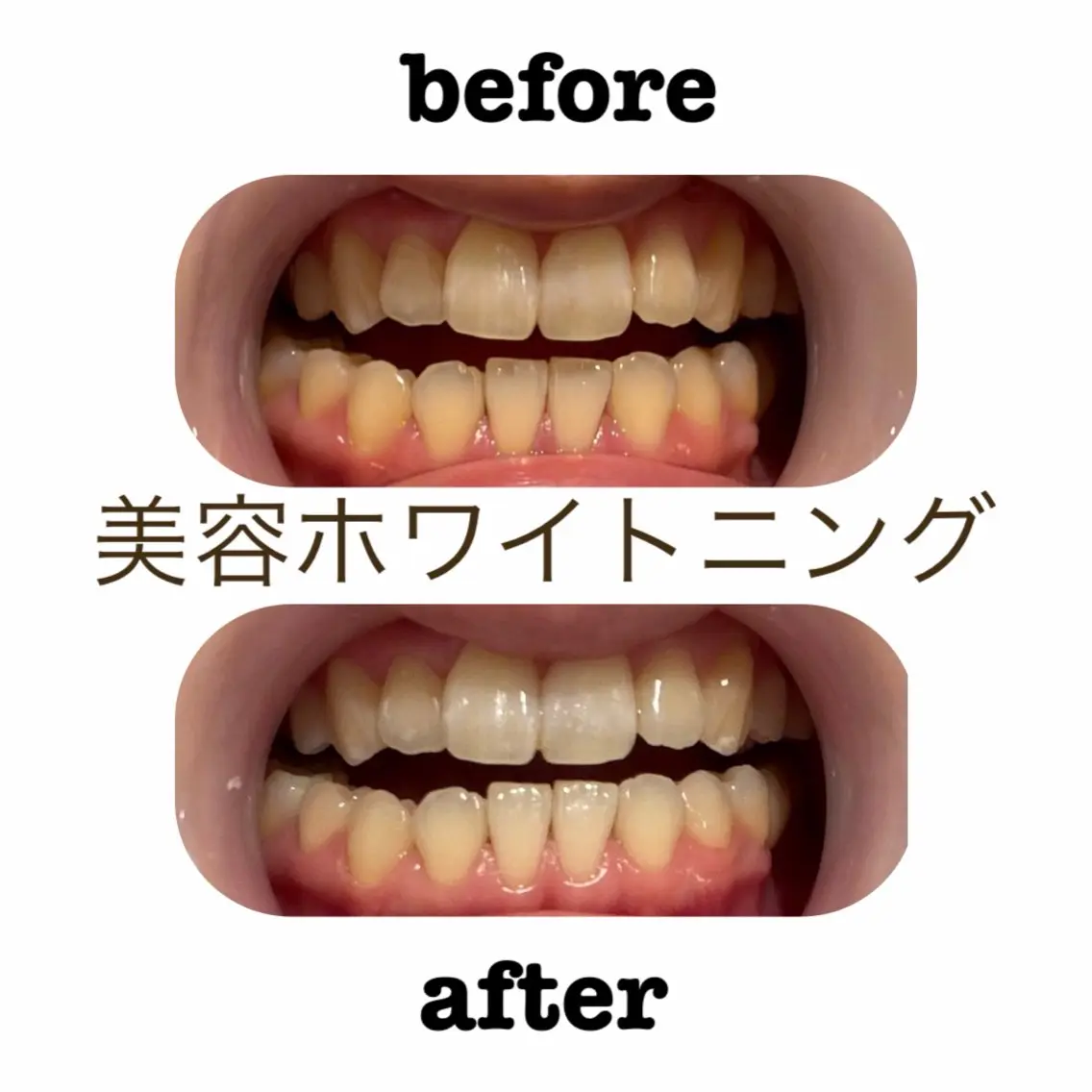 セルフホワイトニング【初回お試し価格】10分照射×2回の写真