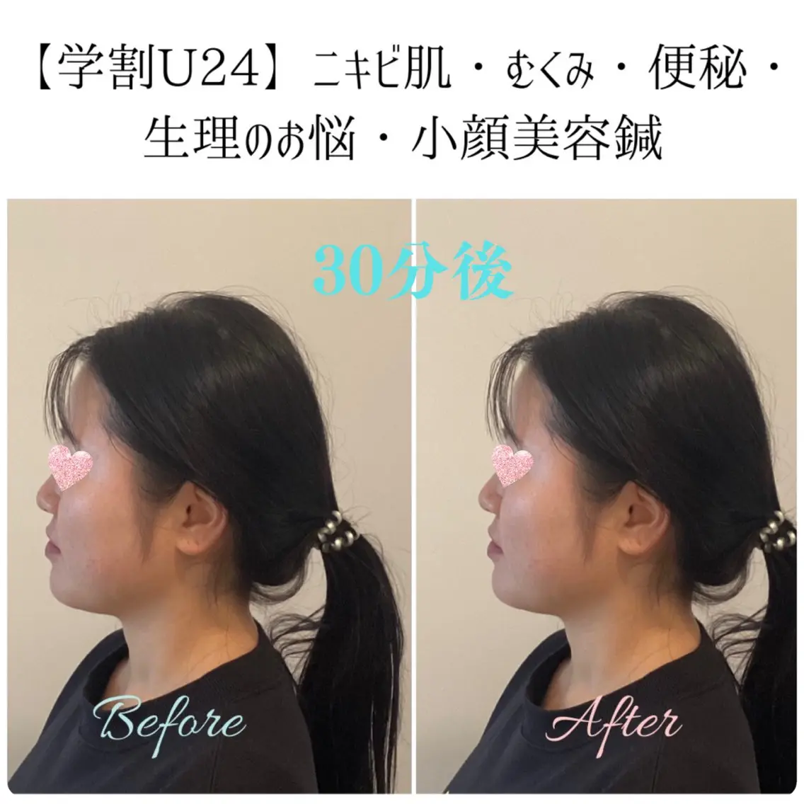 美容鍼&温活・免活 さくらんぼ鍼灸院のエステ・リラクイメージ