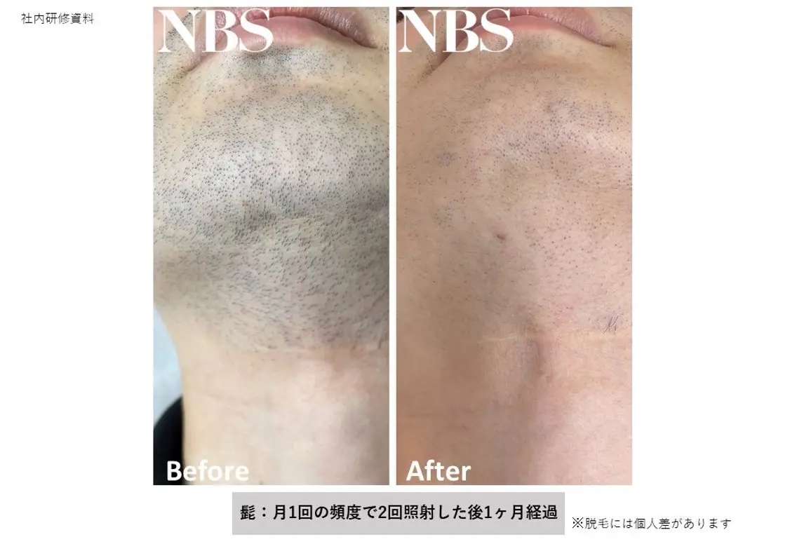 【メンズ】人気No.1ヒゲ脱毛!毎日の髭剃りの時短、肌荒れから解放されます。の写真