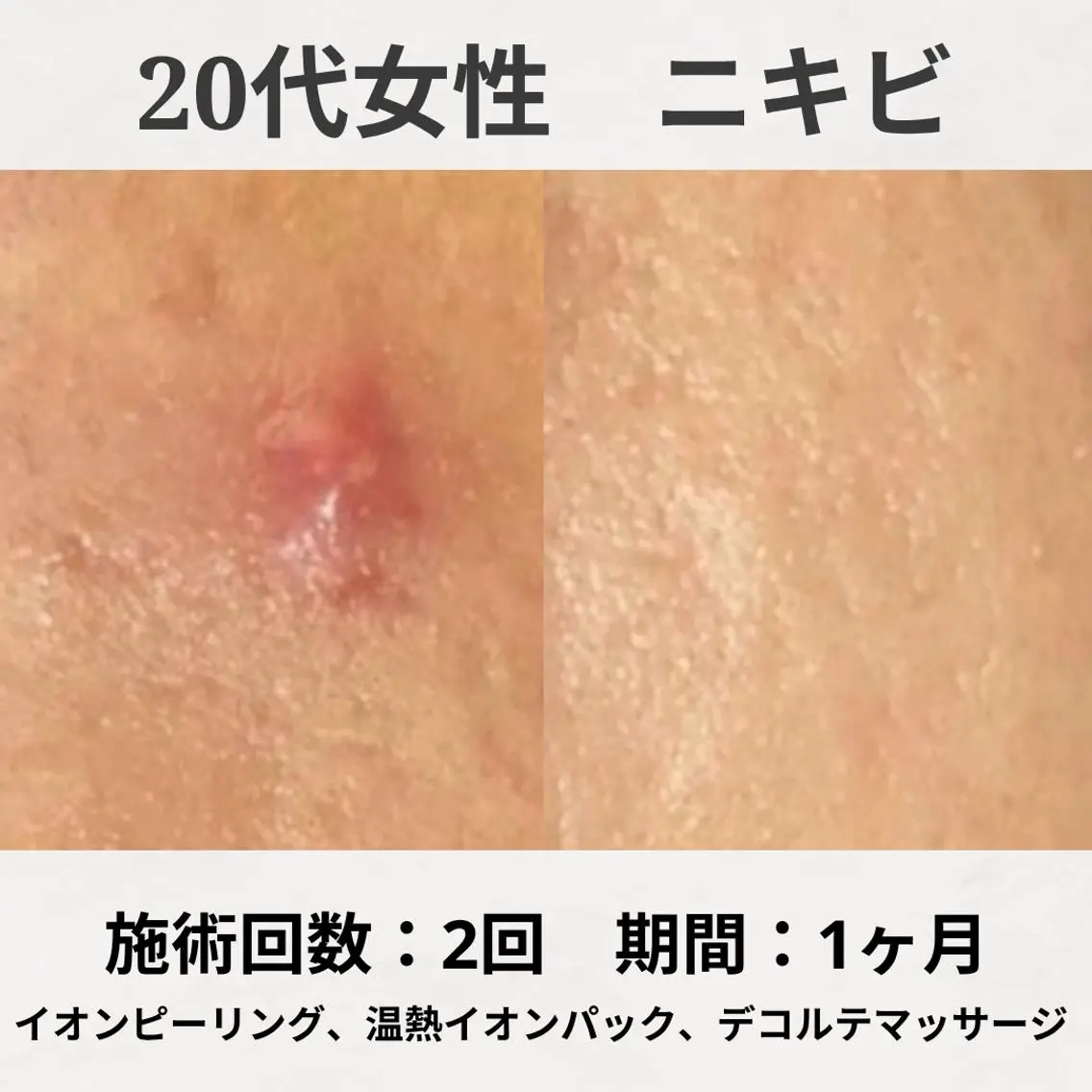 エステ リラク 繰り返すニキビ跡専門 根本改善のエステ・リラクイメージ