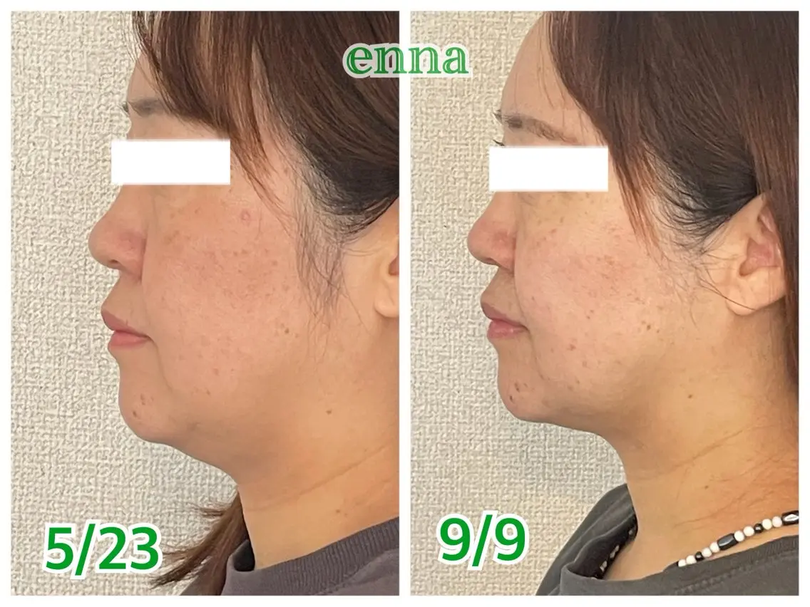 【フェイスライン集中ケア】首との境目のもたつきにお悩みの方への写真