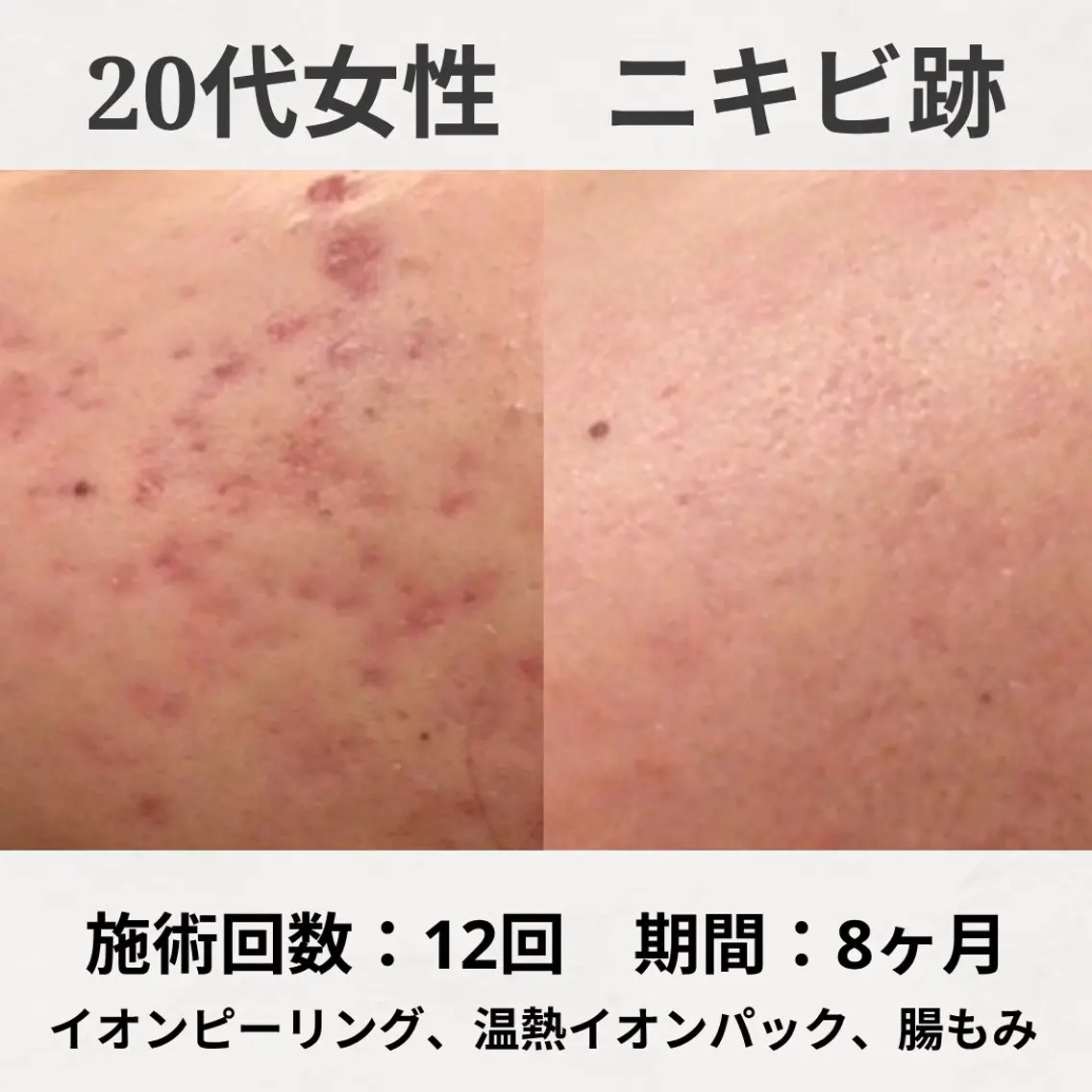 エステ リラク 何をしても繰り返す ニキビ・ニキビ跡専門のエステ・リラクイメージ