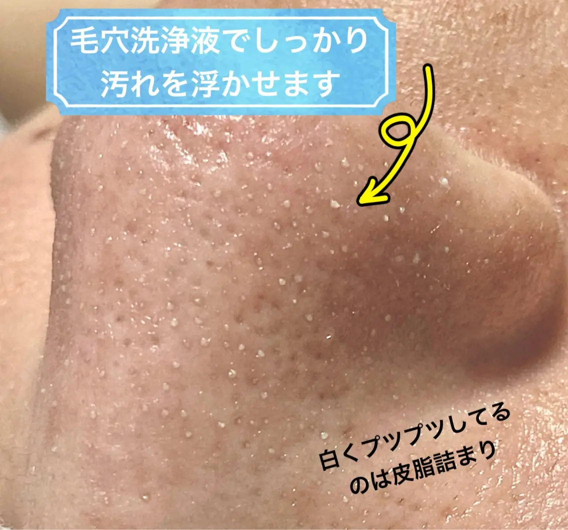 エステ 毛穴洗浄🍀脱毛🍀 光フェイシャル🍀のエステ・リラクイメージ