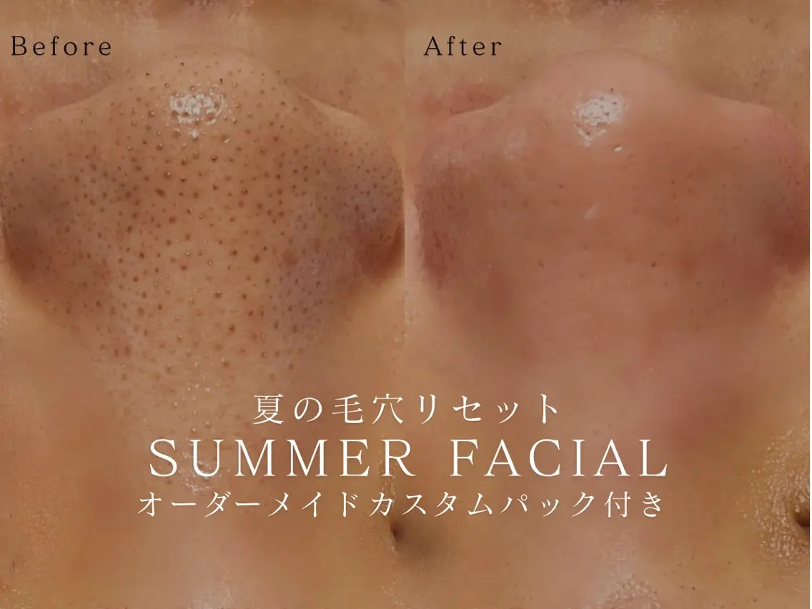 【7月限定】夏の毛穴リセットフェイシャル🌞オーダーメイドカスタムパック付 毛穴洗浄×美容液導入🫧の写真