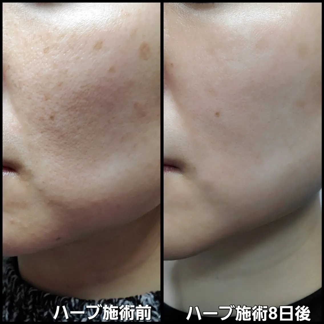 【肌荒れ/ニキビが気になる方へ】美肌を土台から育てる！ハーブ+無料エステ付の写真