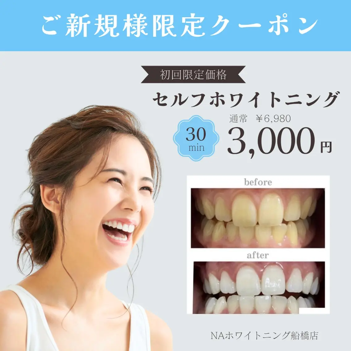 【今月限定】Google口コミでセルフホワイトニング¥6,980→¥3000（照射時間30.分）の写真