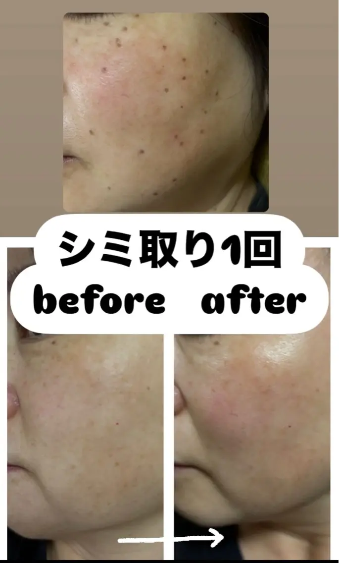 【シミケア】新メニュー🆕20分取り放題シミケアコース🤎50分の写真