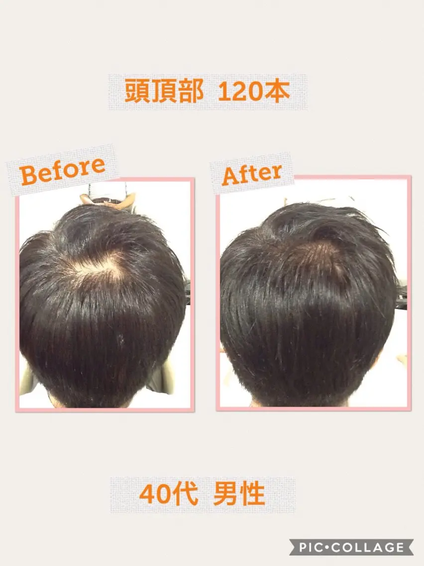 メンズ 分け目・つむじ 自然増毛専門のヘアスタイル