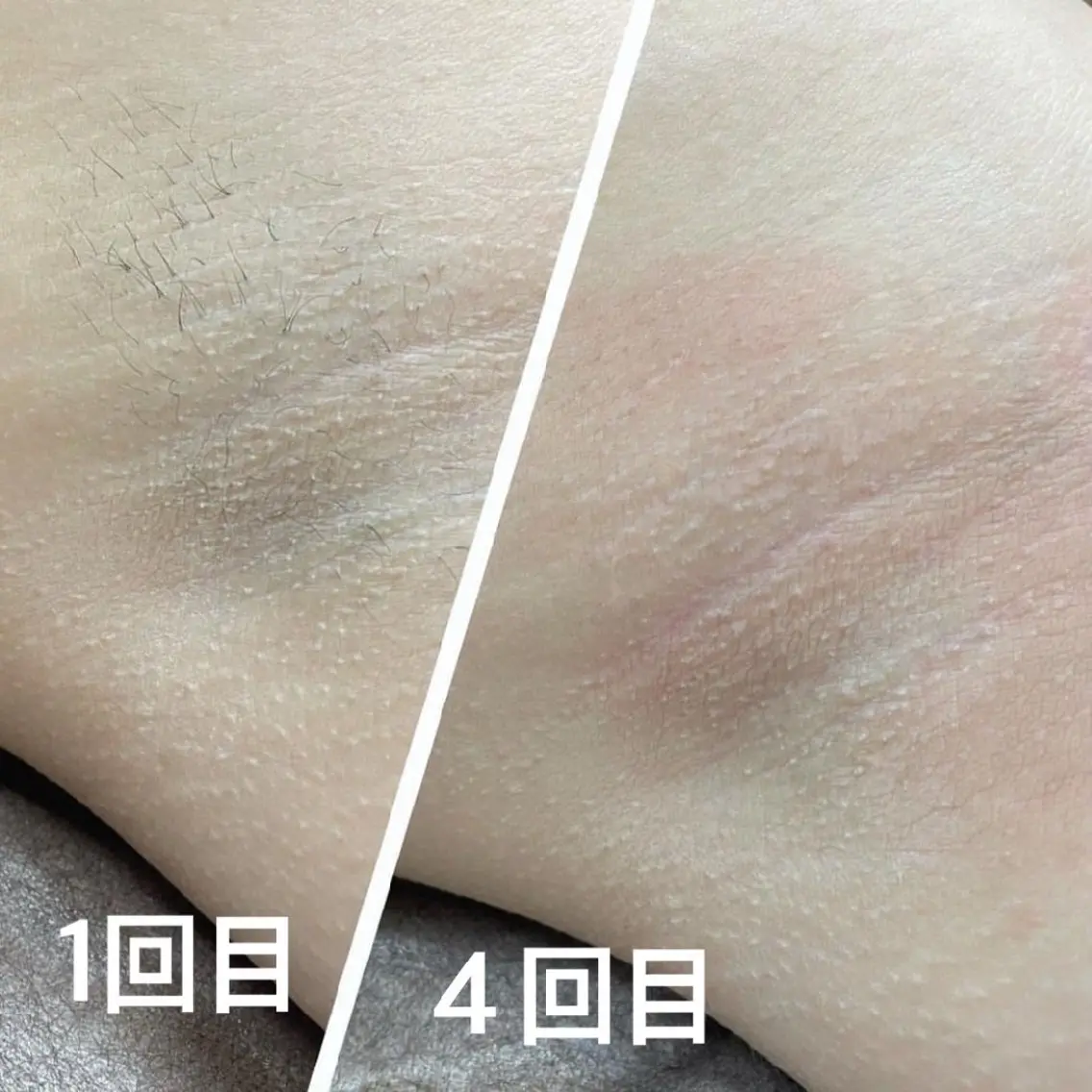 【夏直前50%OFF☀️】LED脱毛全身(顔、VIO込み)の写真