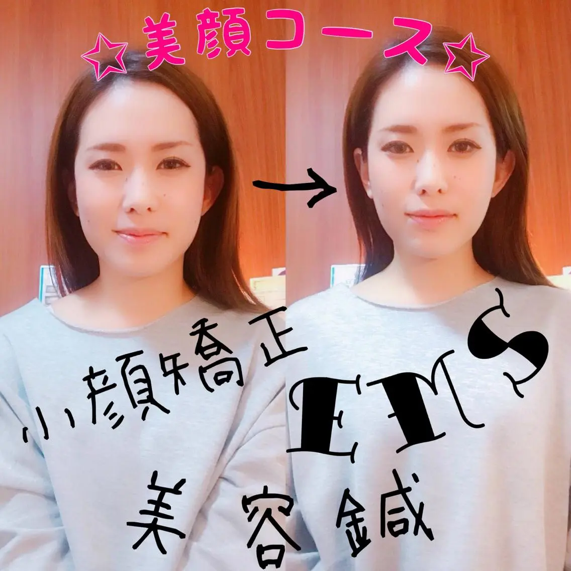 【美顔コース】▷美顔鍼50本▷パルス美顔鍼▷美顔矯正(小顔矯正+頭蓋骨矯正)▷エレクトロ小顔調整▷炭酸ミストの写真