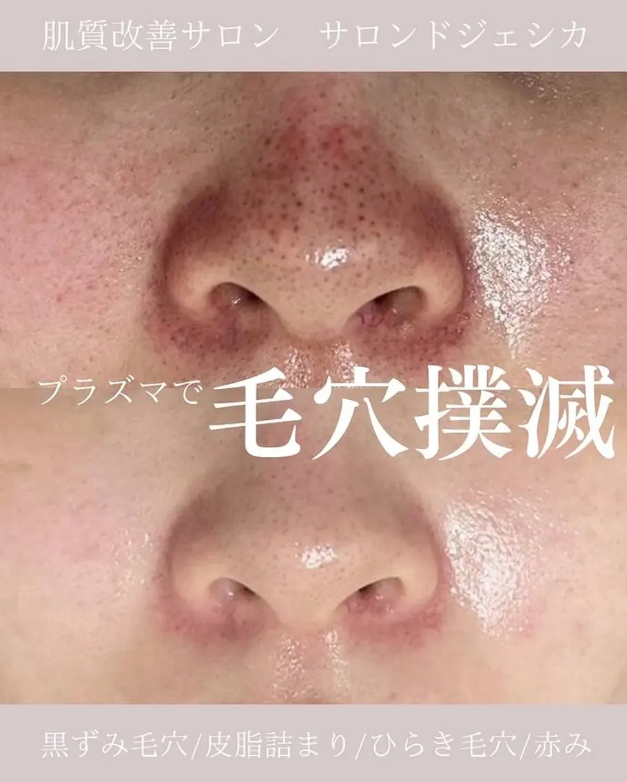 【施術人数4万人突破記念✨いちご鼻・角栓・ひらき毛穴撃退！】毛穴肌管理フェイシャル🉐ミニモ限定の写真