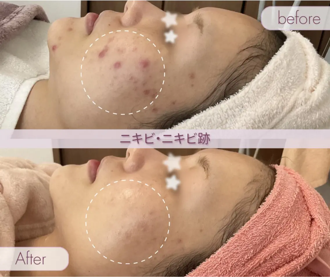 エステ 肌質改善サロン ココマヒナのエステ・リラクイメージ
