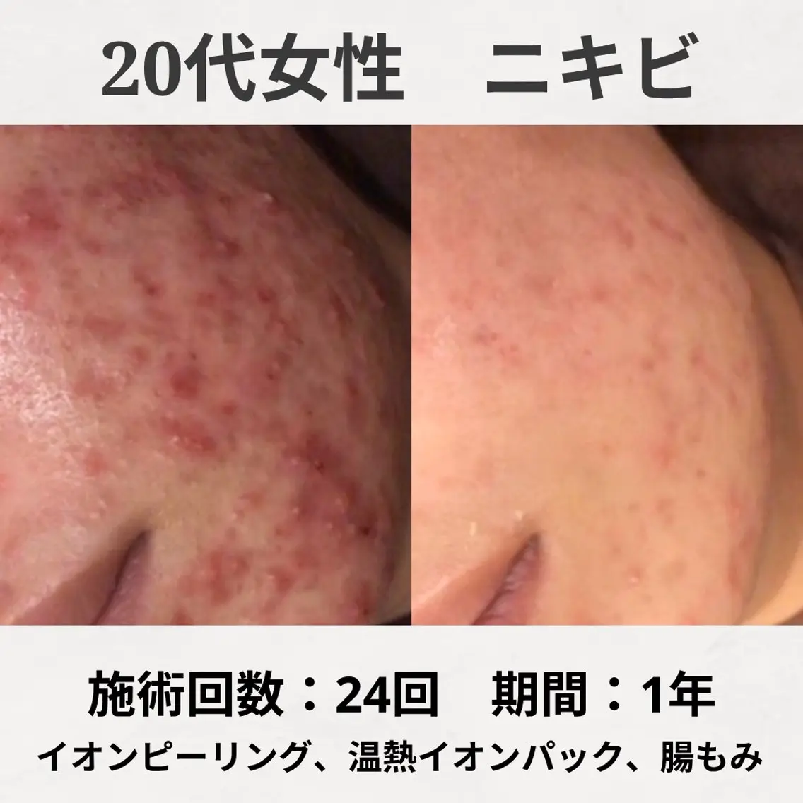 エステ リラク 繰り返すニキビ跡専門 根本改善のエステ・リラクイメージ