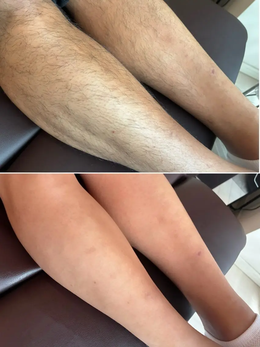 【蒲田駅徒歩2分】夏準備スタート🌻 腕&脚 wax光脱毛で速攻ツルスベ肌へ!men'sの写真