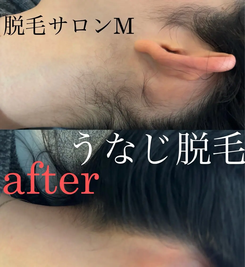 《うなじえりあし脱毛¥1,980》メンズもキッズも🙆♀の写真