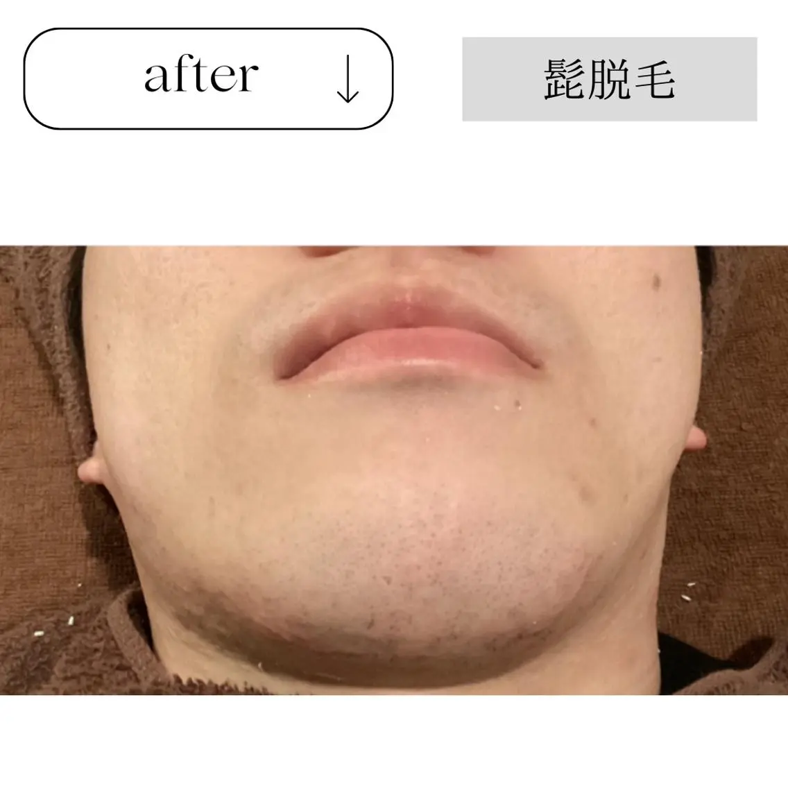脱毛 beauty CHOOSEのエステ・リラクイメージ