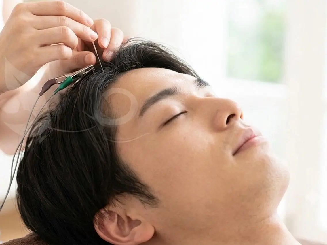 【初回限定】メンズエステ◎髪のボリューム・頭皮環境を整える電流育毛促進鍼トライアル【その場で口コミで200円OFF!】の写真