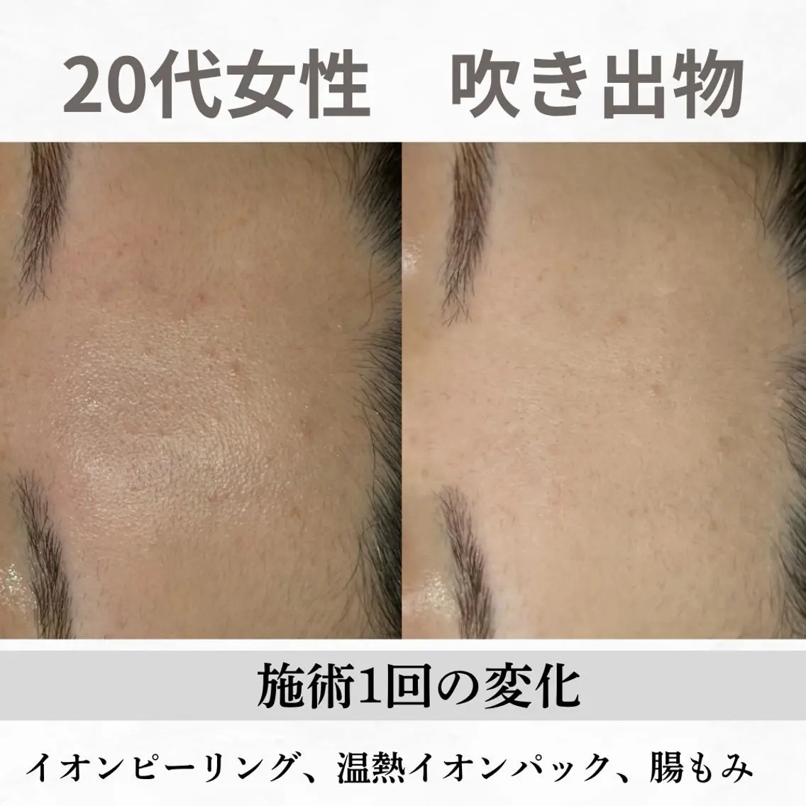 重度ニキビ専門🌼 ダウンタイムなしのエステ・リラクイメージ