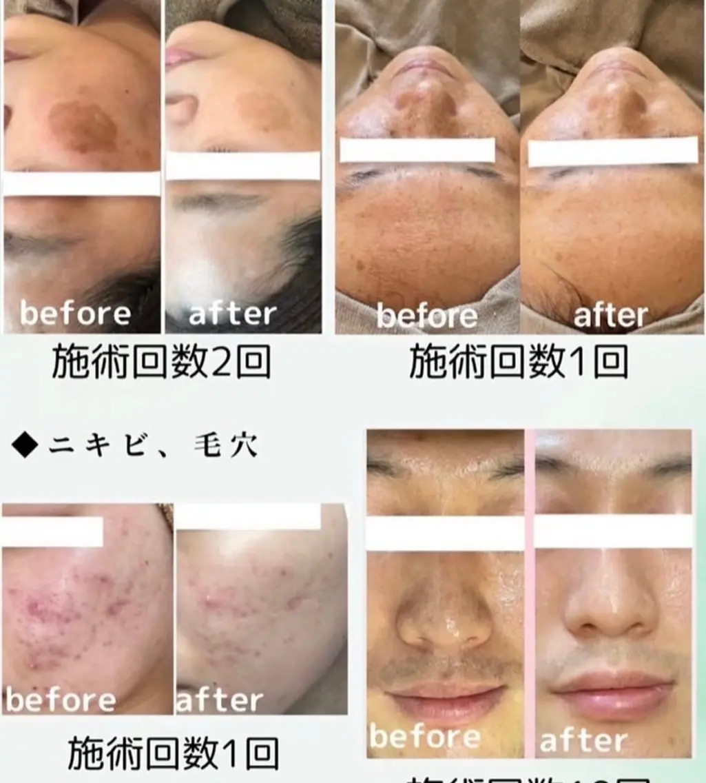 次世代ハーブトリートメント🌿肌質改善、シミ、シワ、ニキビ肌、ニキビ後、毛穴、黒ずみ、美白の写真