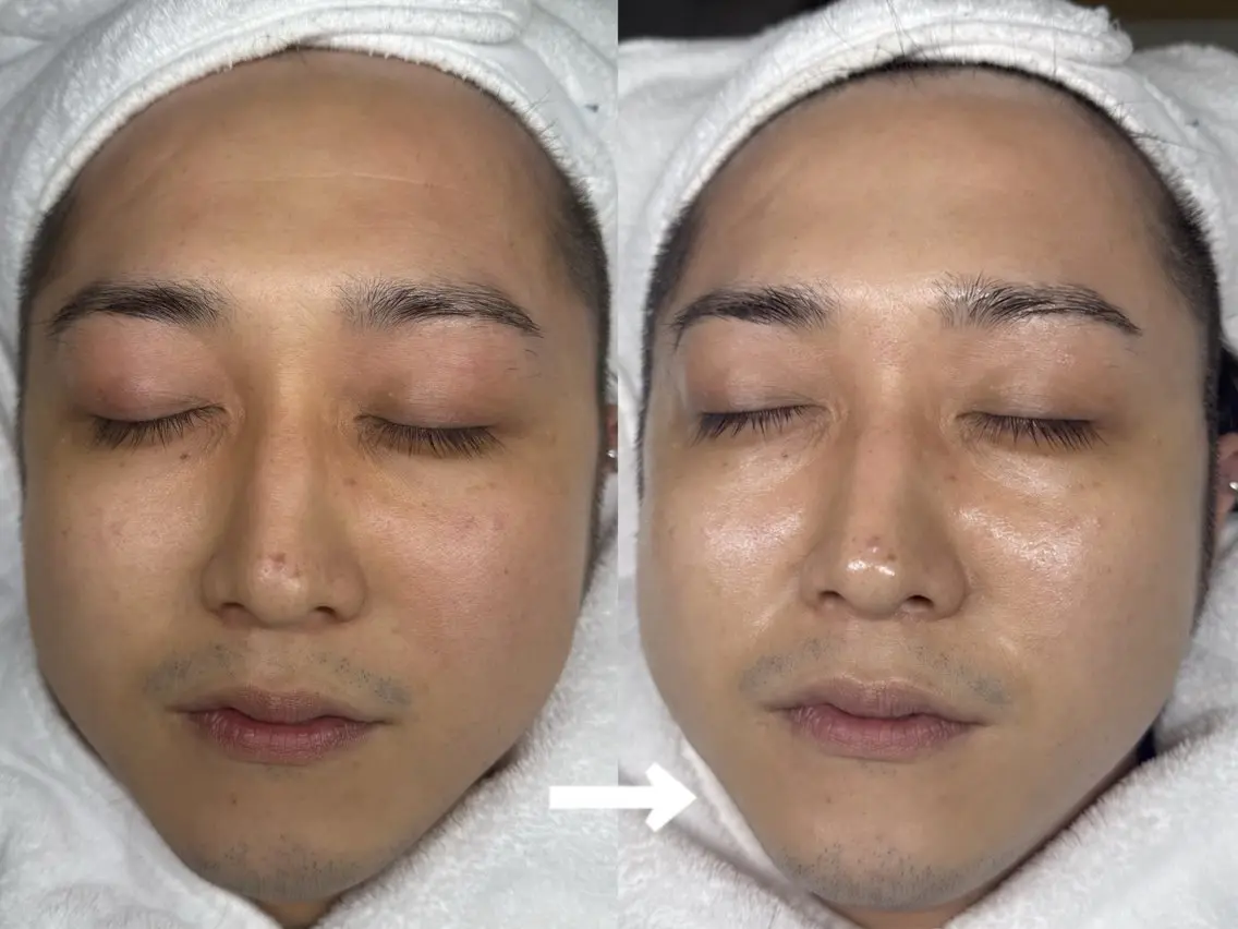 メンズ水分管理メニューの写真