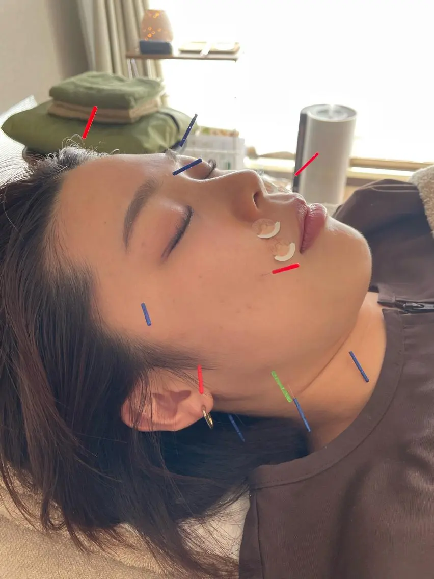 【ミニモ限定】U24学割！美容鍼💆🏻‍♀️(通電あり•なし)の写真