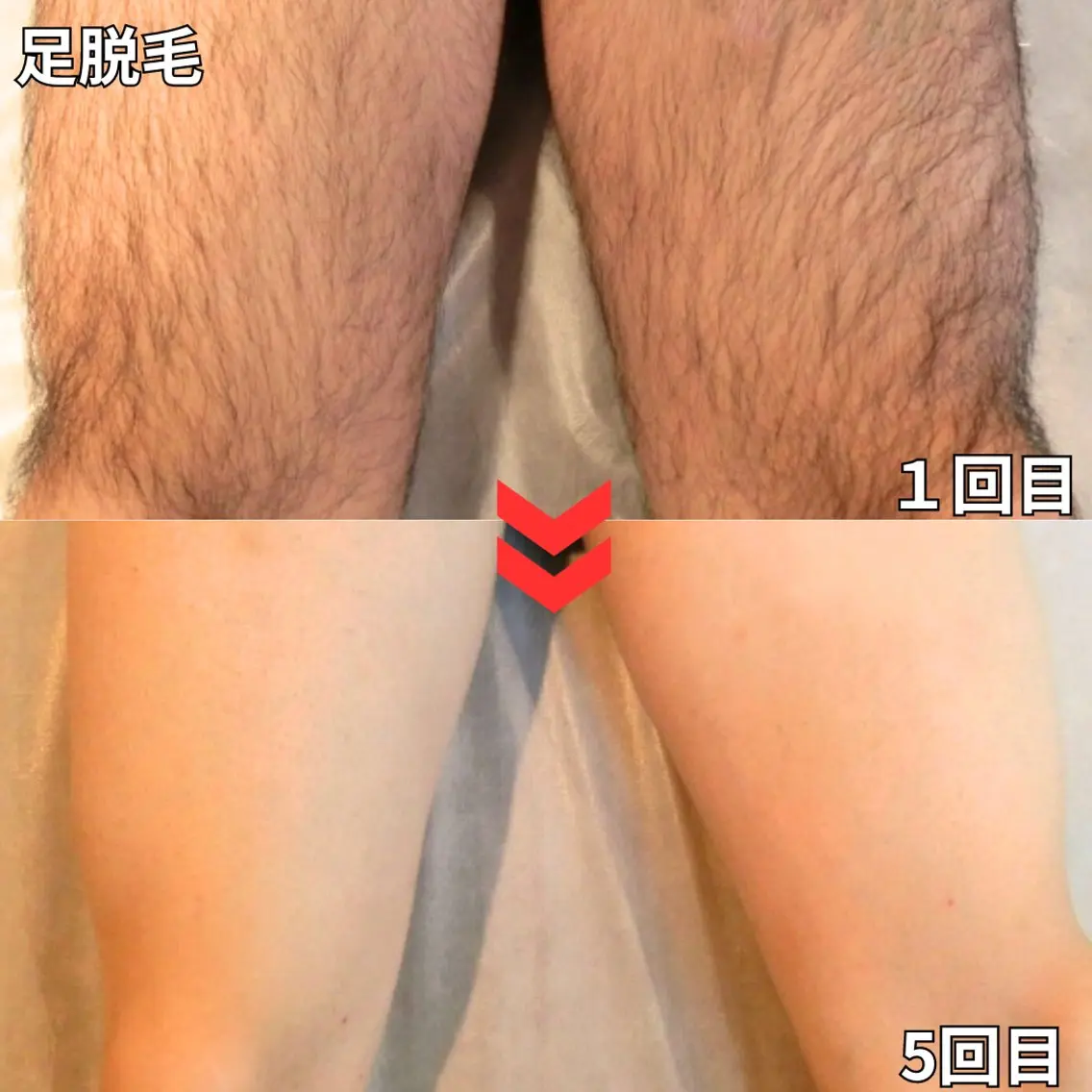 【ミニモ初回限定50%オフ】膝下から足首脱毛の写真