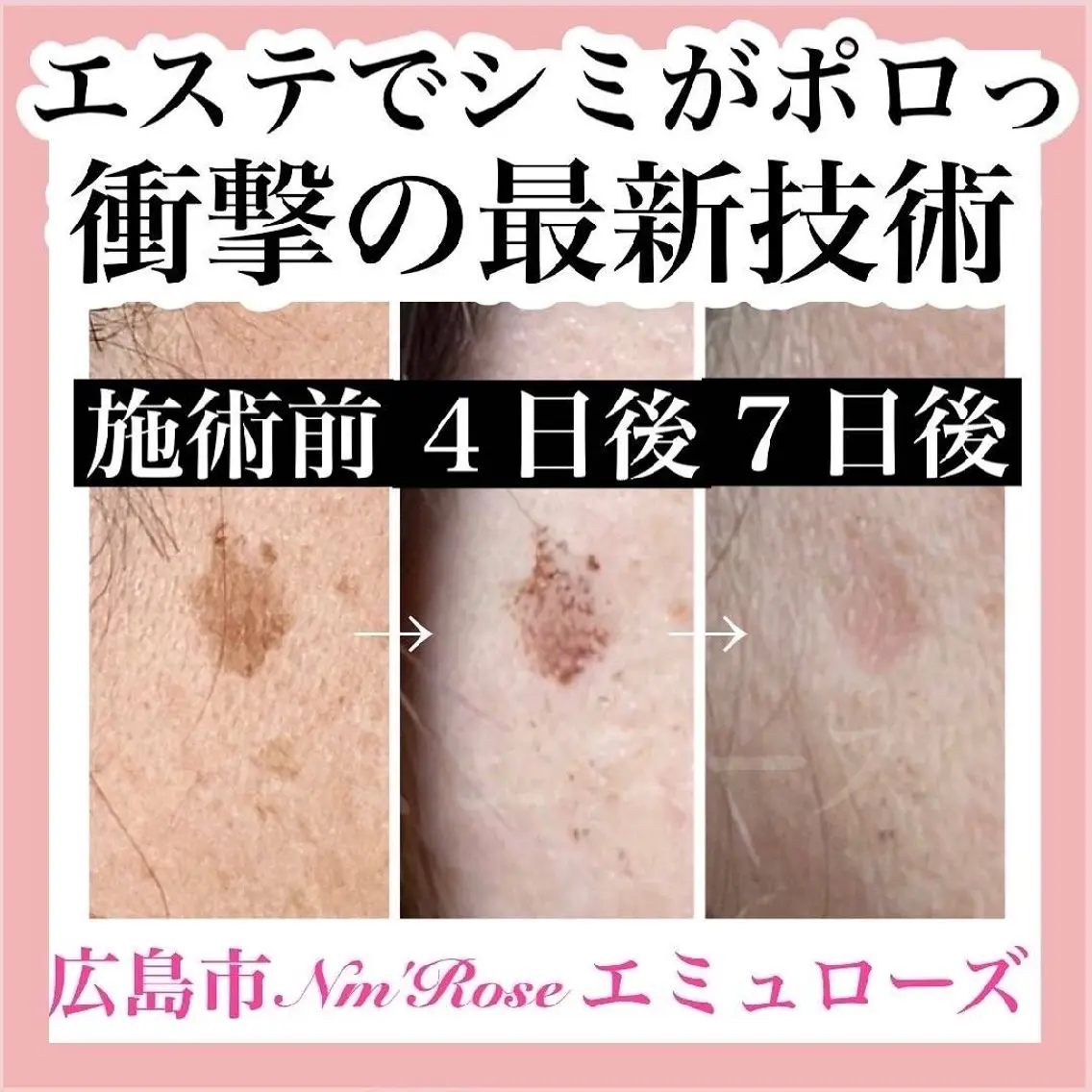 \人気No.1/【シミ·しわ特化】お悩み全解消！光打ち放題の写真