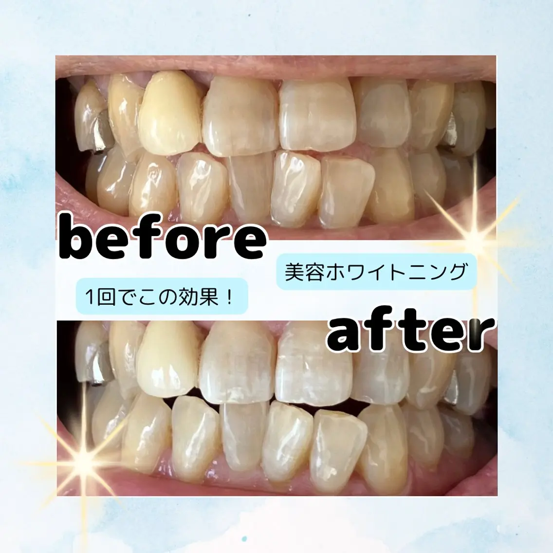 リピーター様専用✨ご来店時に次回予約✨美容ホワイトニング8分3照射4500→4000円🦷の写真
