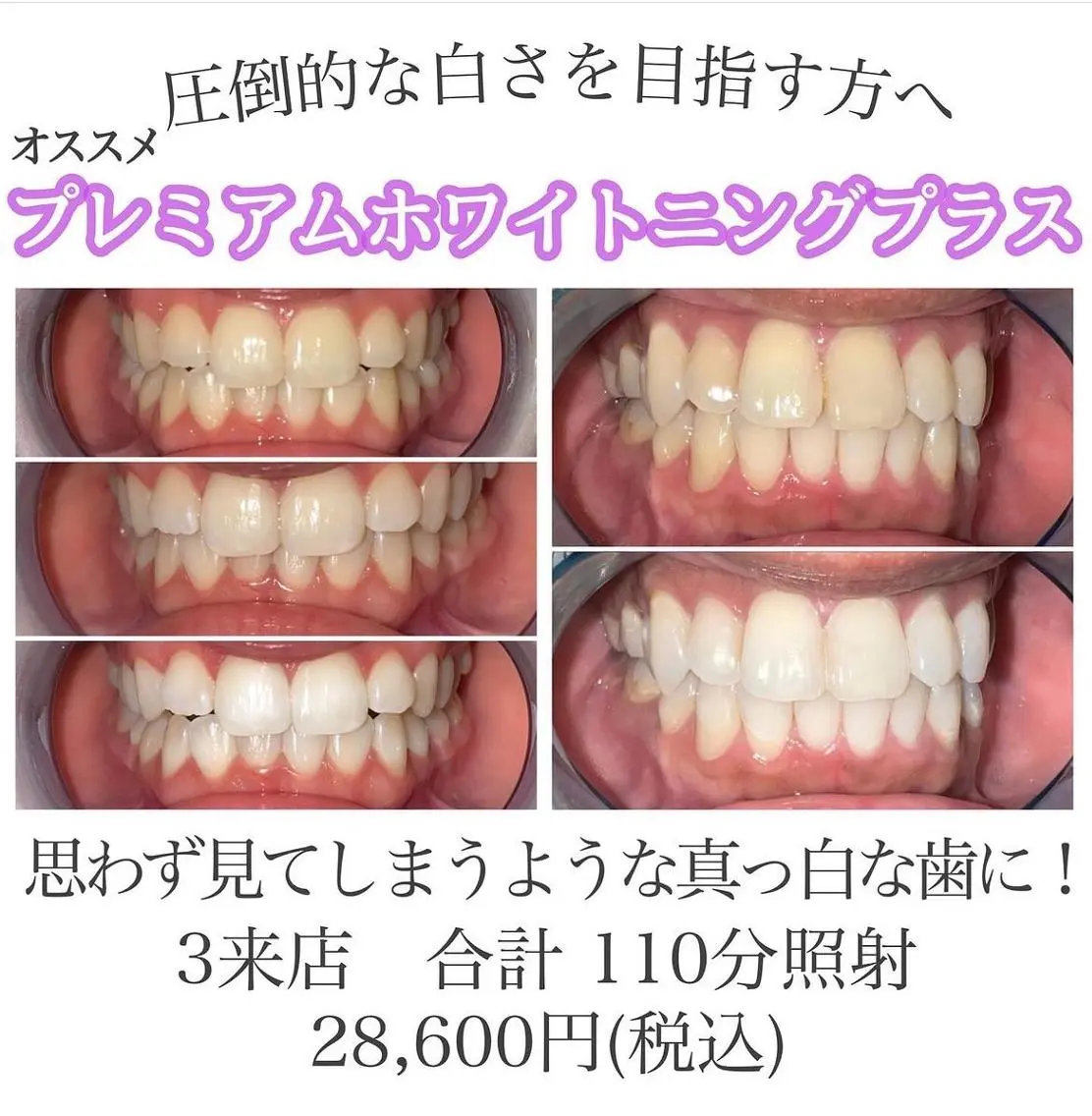 【超お得】プレミアムホワイトニングプラス 3来店計110分照射 短期集中ホワイトニングケアに🦷✨の写真