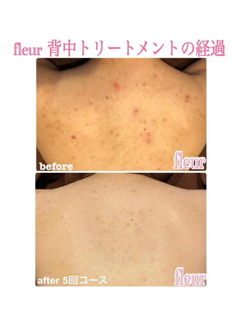 【背中トリートメント】背中こそ美意識を感じる✨✨360度抜かりなく綺麗な肌を作る✨エクスビアンスピーリング🇺🇸🗽✨の写真
