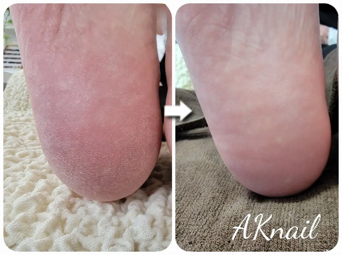 ネイル&巻き爪サロン AKnailのネイルデザイン