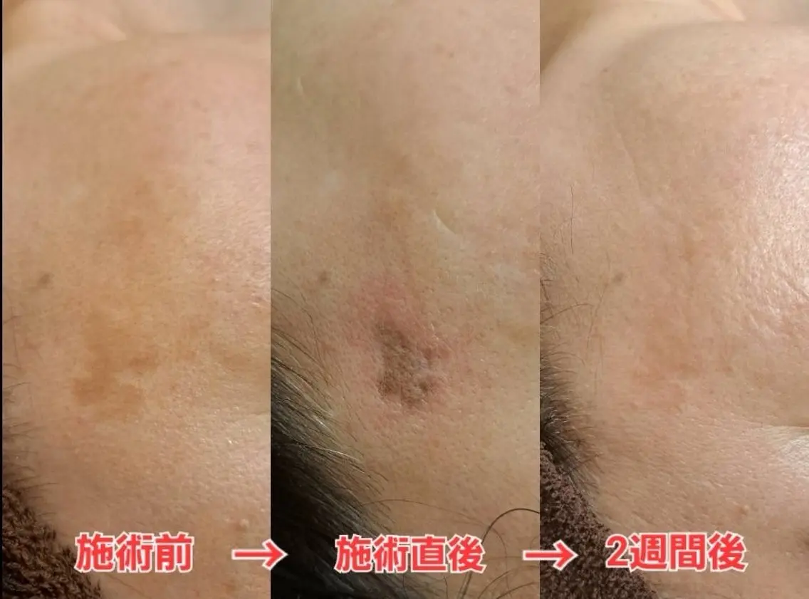しみケアデトックス20分の写真