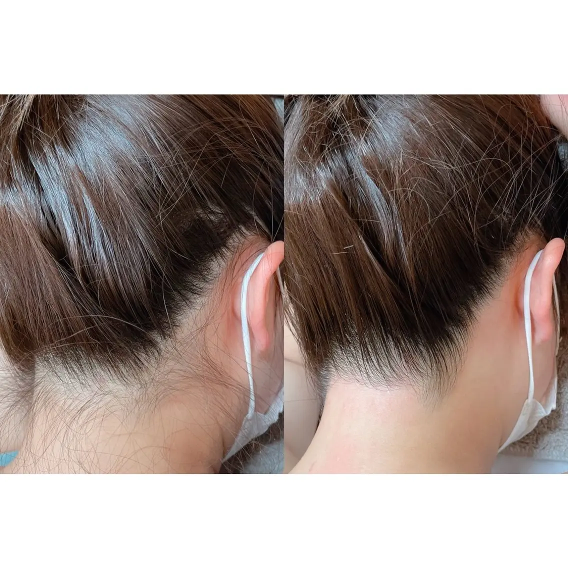 💫当日限定💫うなじダブル脱毛(ワックス+最新ハイブリッド光脱毛)撮影モデル◎3000円の写真