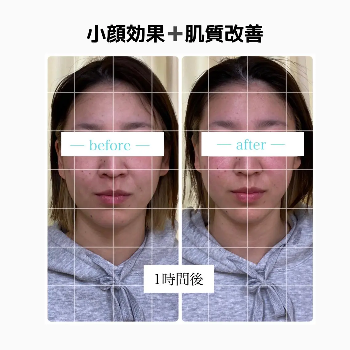 🌈美容鍼(刺さない)➕筋肉ほぐし➕美顔器(リフトアップ)🌈速攻劇的小顔効果の写真