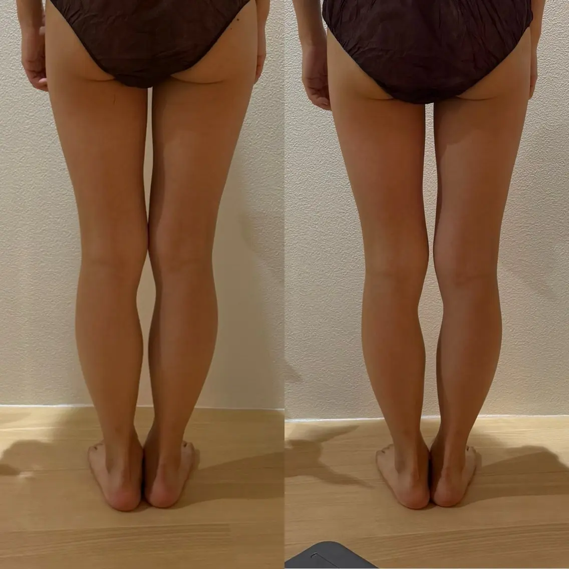 【✨下半身orお腹まわり ダイエット効果抜群✨】キャビテーション&ラジオ波&バキューム60分コースの写真