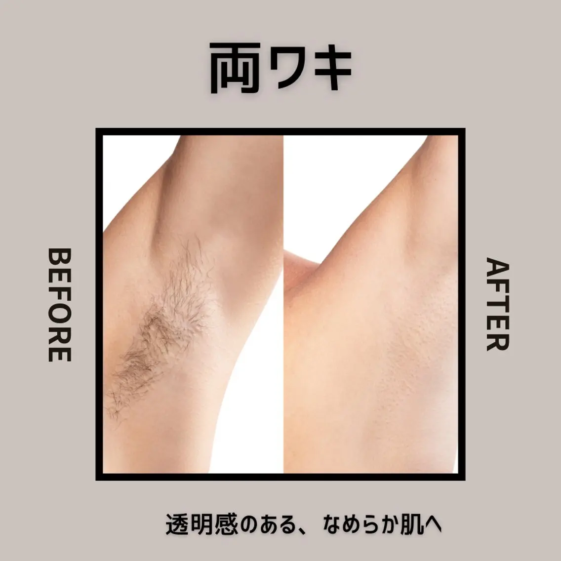 【自己処理だけは黒ずみの元!】 両ワキの写真