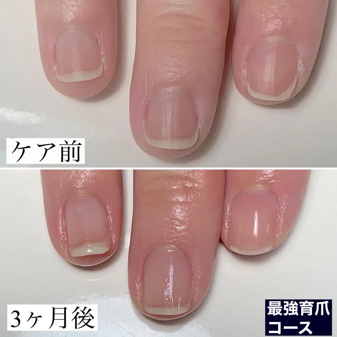 自爪でお悩みの育成ケア1回体験コース・・・モニター価格の写真