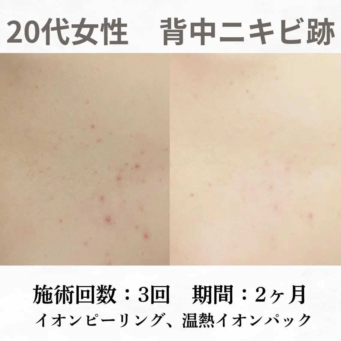 重度ニキビ専門🌷 ダウンタイムなしのエステ・リラクイメージ