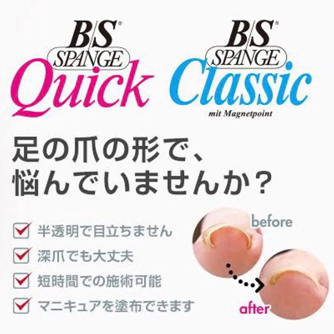 【新規限定】巻き爪矯正・BS 1本コースの写真
