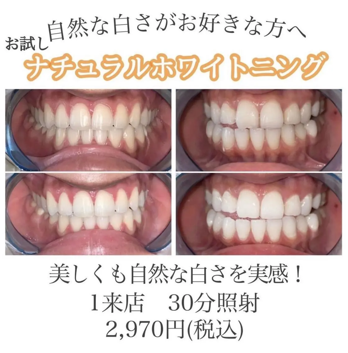 【初回体験✨】お試しセルフホワイトニング計30分照射 痛みなく自然な白さへの写真