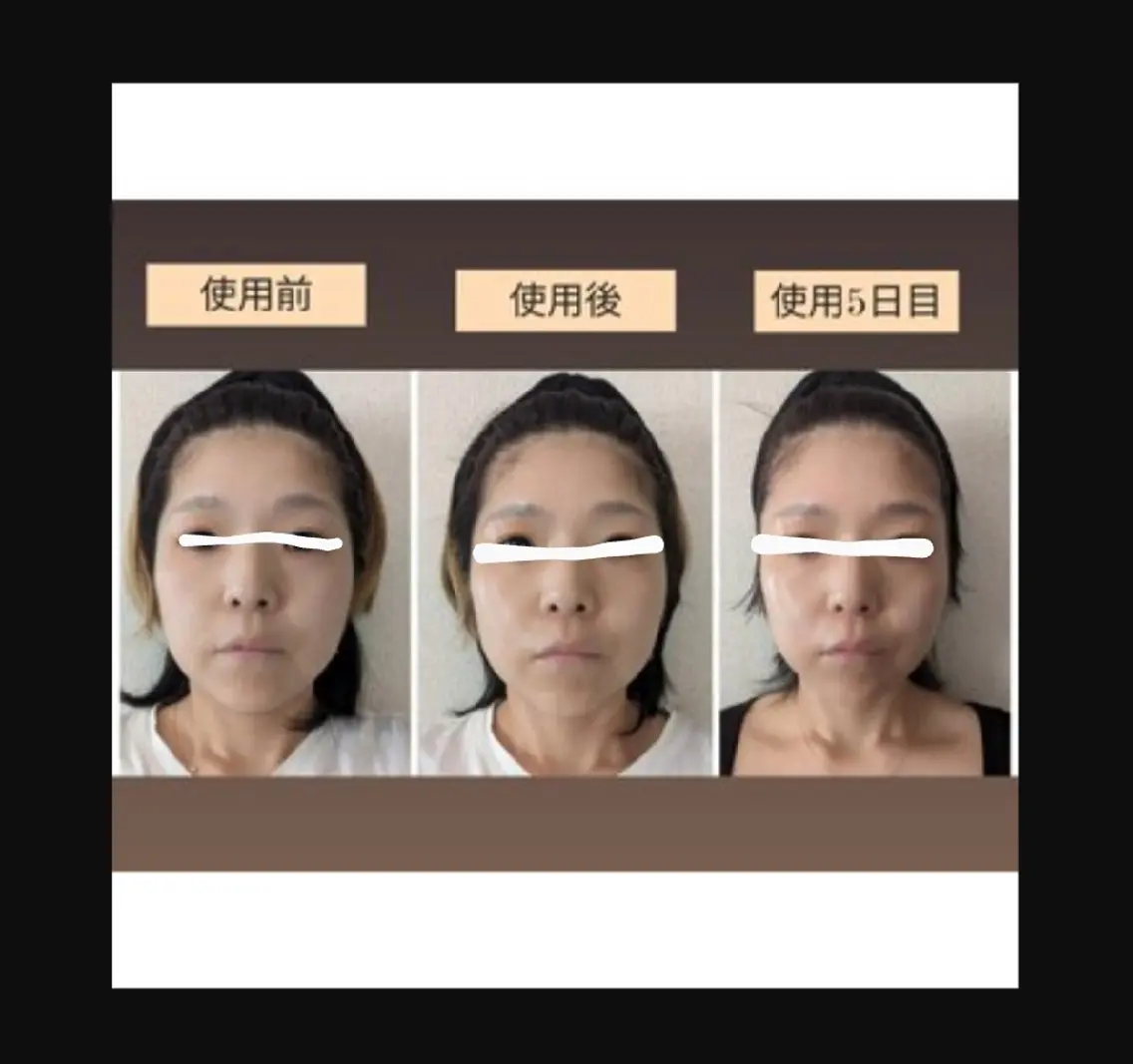 EMS搭載！3in1美顔器使用のトリートメントの写真